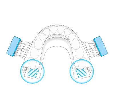 Prefabricated oral appliance mandibular
